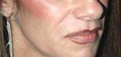 Juvederm New York Before Patient 4